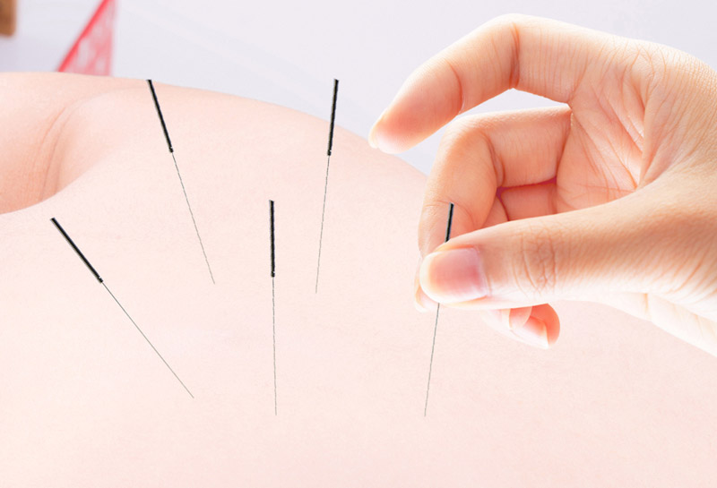 심부근육자극침(Dry Needling)치료