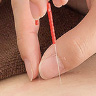 심부근육자극침(Dry Needling)치료